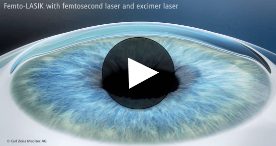 LASIK thumbnail with play button